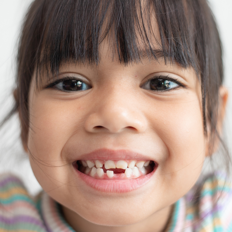 Niños en dentición Mixta